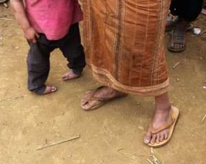 Before treatment Loi's feet were severely twisted and she had to walk on the sides of her feet.  Each year it became more difficult for her to bear her own weight.