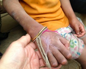 Nan's hand and arm swelled to the point that her flesh split in three locations